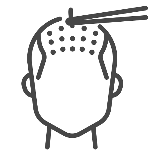 Best Hair Transplant Treatment clinic in Perinrthalmanna