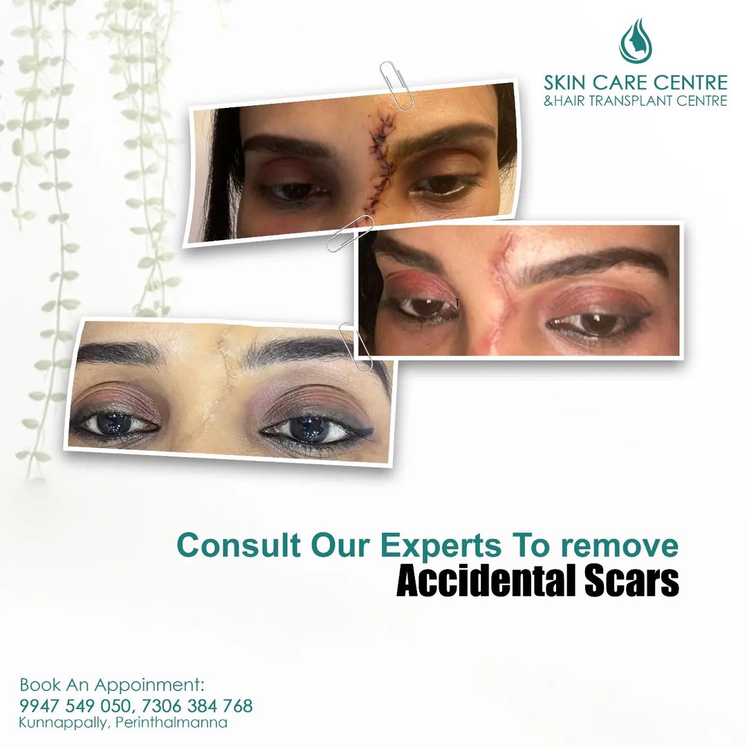 Skin care clinic in Perinthalmanna