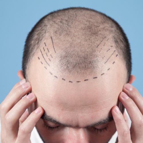 Best Hair Transplant Treatment clinic in Perinrthalmanna