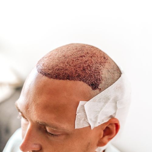 Best Hair Transplant Treatment clinic in Perinrthalmanna