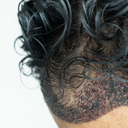 Best Hair Transplant Treatment clinic in Perinrthalmanna