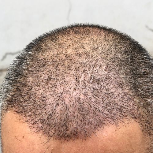 Best Hair Transplant Treatment clinic in Perinrthalmanna