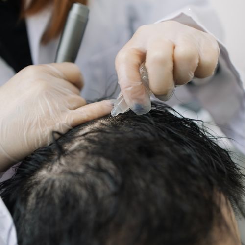 Hair Loss Treatment in Perinthalmanna