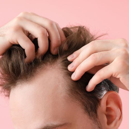 Best Hair Transplant Treatment clinic in Perinrthalmanna