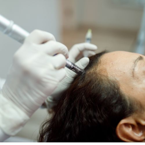 Hair Loss Treatment in Perinthalmanna