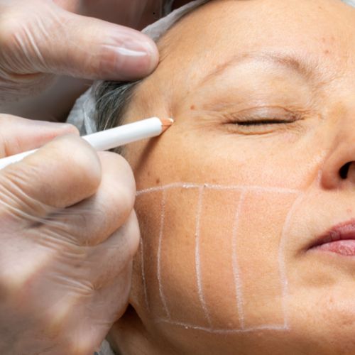 Best Hifu Treatment in Malappuram