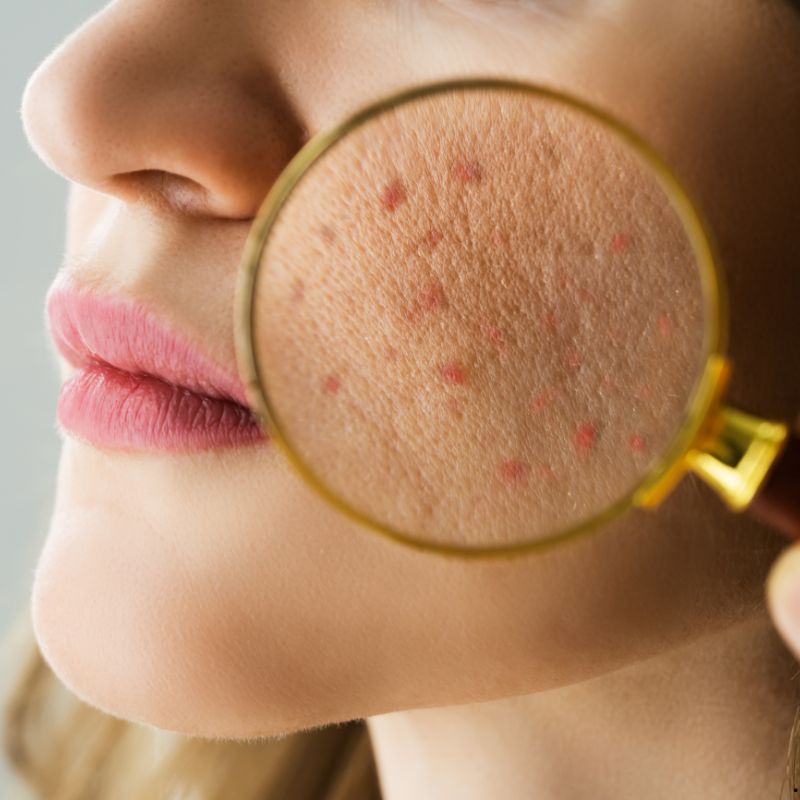 Hydra Facial in Perinthalmanna
