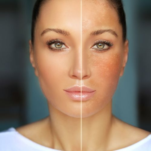 Hydra Facial in Perinthalmanna