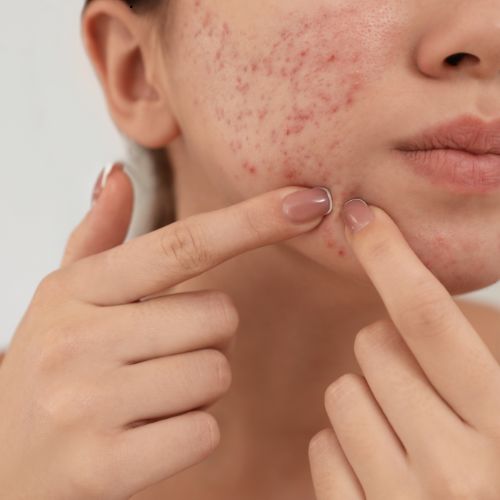 Hydra Facial in Perinthalmanna