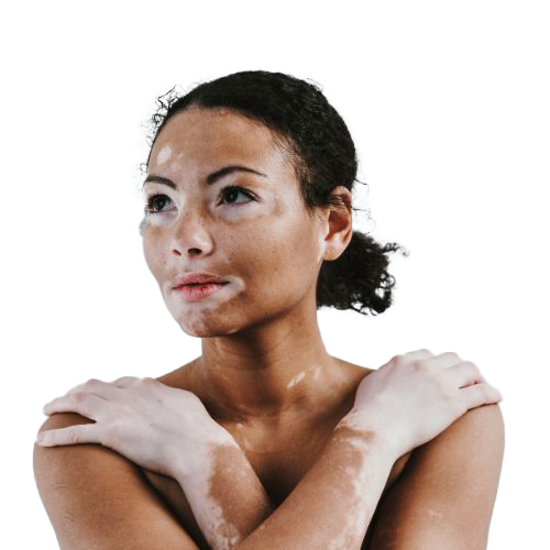 Best Vitiligo Treatment in Malappuram